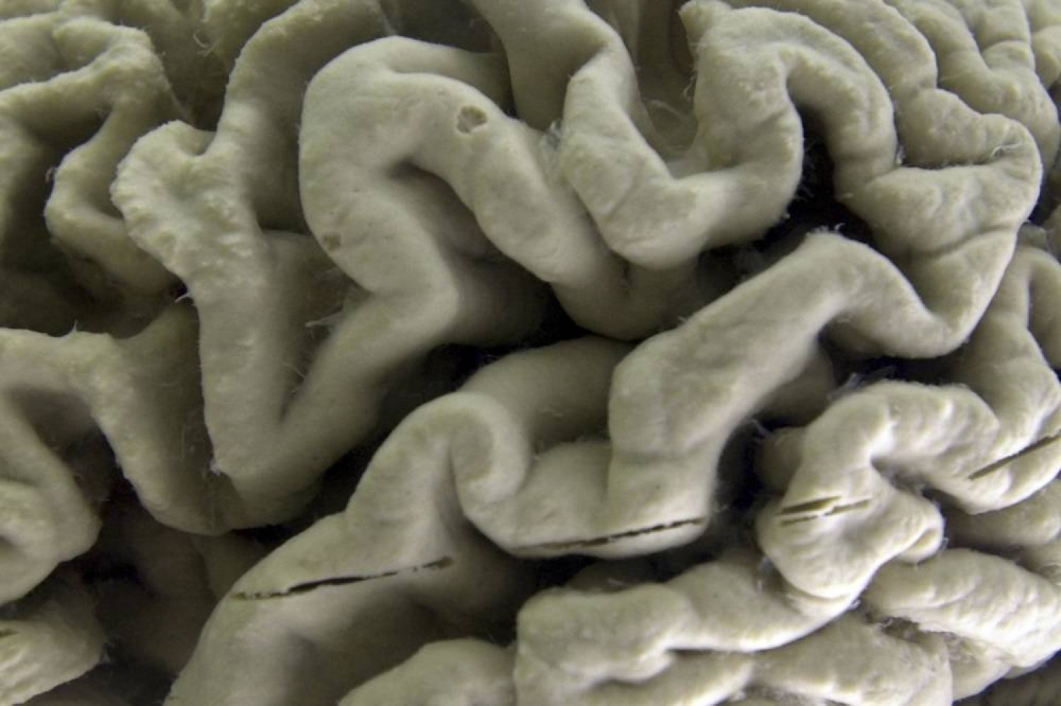 جزء من دماغ بشري مصاب بمرض ألزهايمر في متحف التشريح العصبي في جامعة «بوفالو نيويورك» (أ.ب)