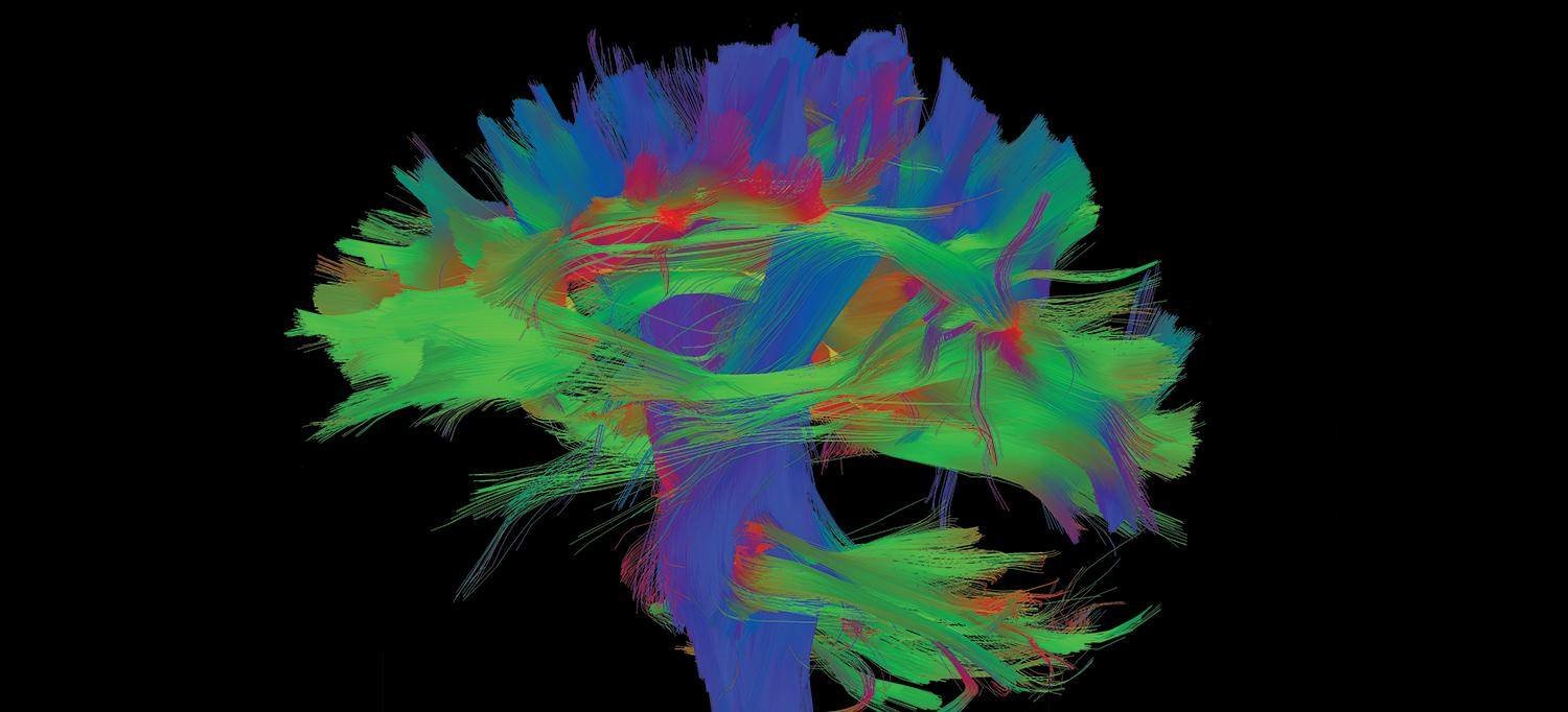 تم استخدام التصوير بالرنين المغناطيسي لإنشاء هذه الخريطة الملونة للمسارات العصبية ( YVONNE W. LUI, MD, AND EYAL LOTAN, MD)