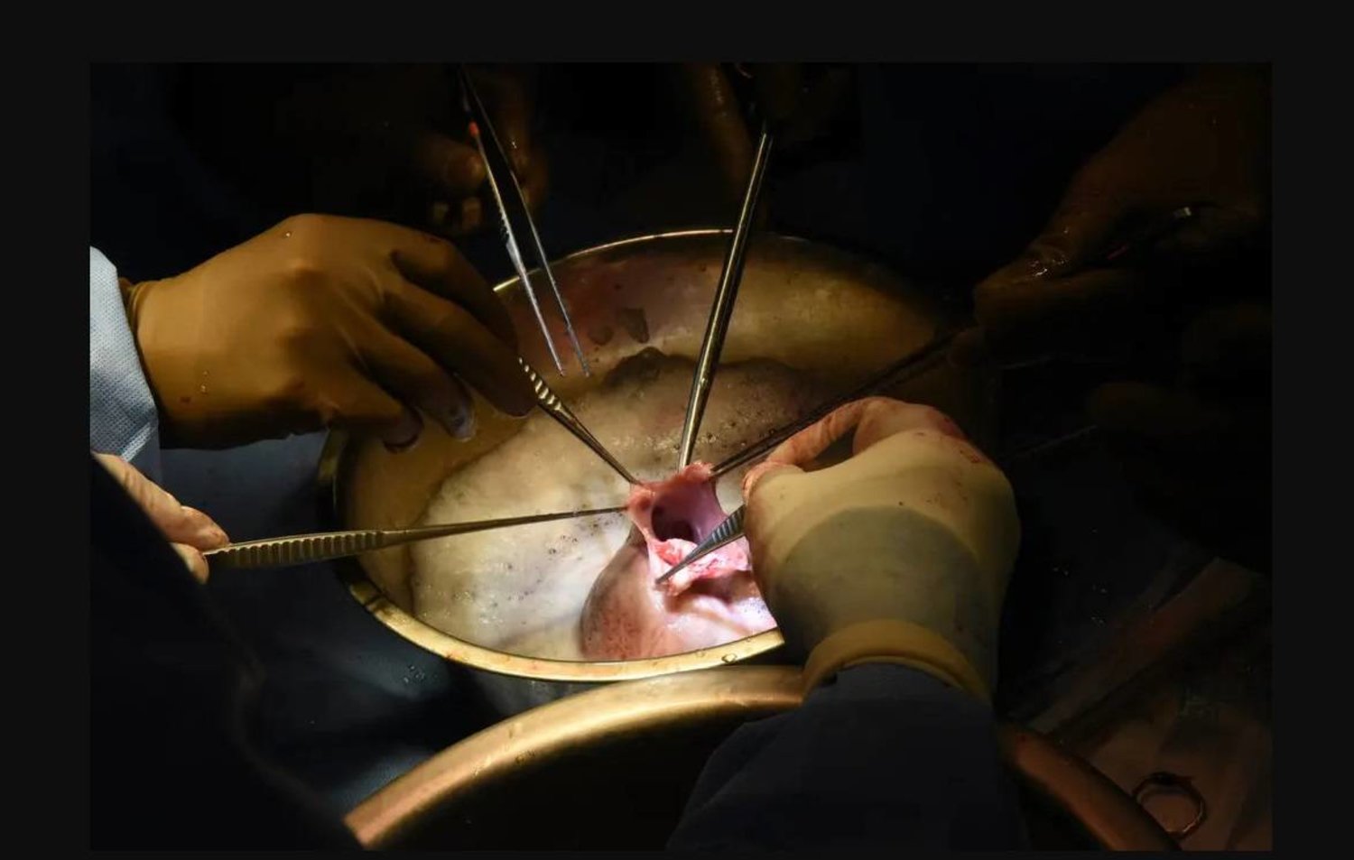 جراحون يفحصون قلب خنزير أثناء الجراحة التي أجروها للورانس فوسيت (أ.ب)