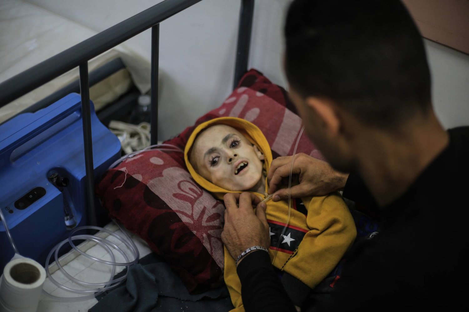 الطفل الفلسطيني يزن الكفارنة خلال تلقيه الرعاية الصحية في رفح وسط الحرب الإسرائيلية على غزة (د.ب.أ)