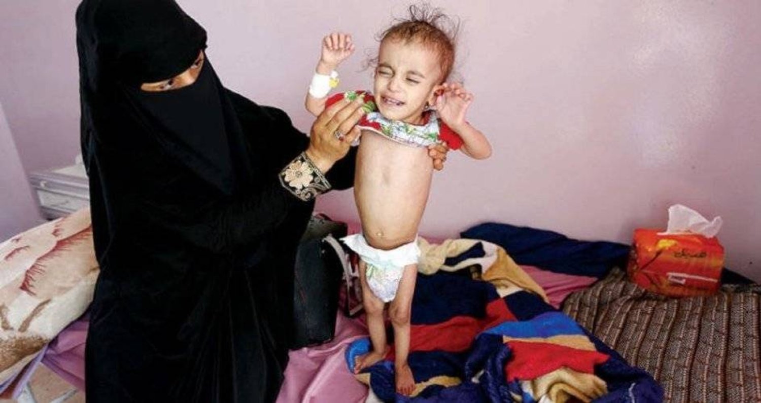يمنية مع طفلتها المريضة في مستشفى «السبعين» بصنعاء (أ.ف.ب)