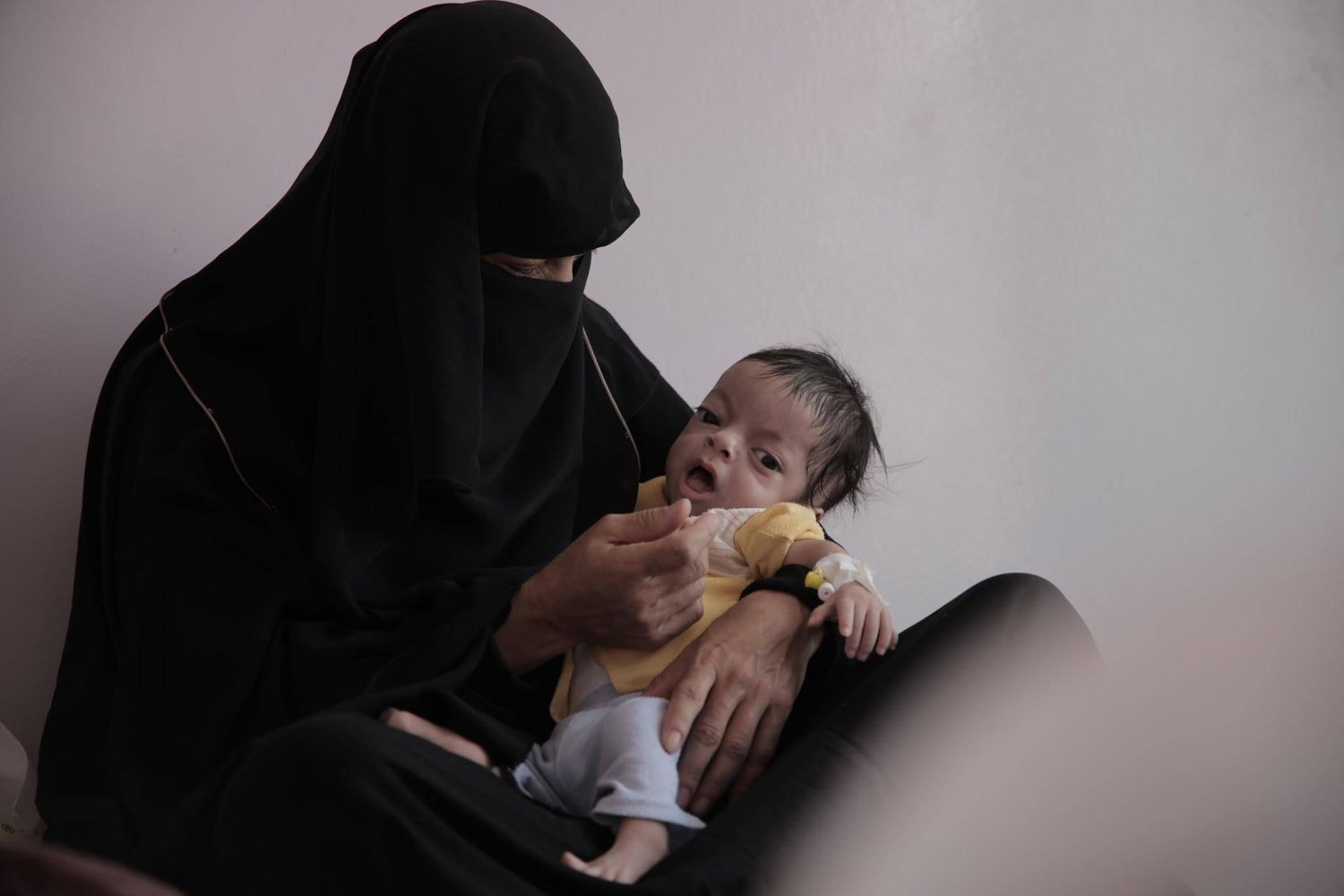 سوء التغذية بين الأطفال اليمنيين ارتفع وانتشرت الأمراض المعدية على نطاق واسع (الأمم المتحدة)